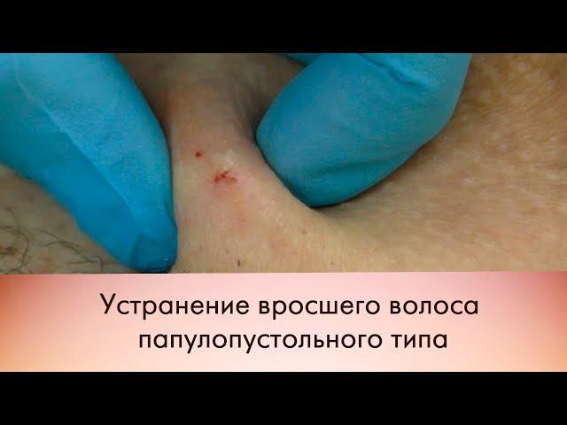 Устранение вросшего волоса папулопустольного типа\Eliminating ingrown hair papulopustulosa type