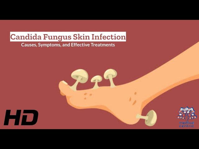 Candida Fungus Skin Infection Explained: What You Need to Know