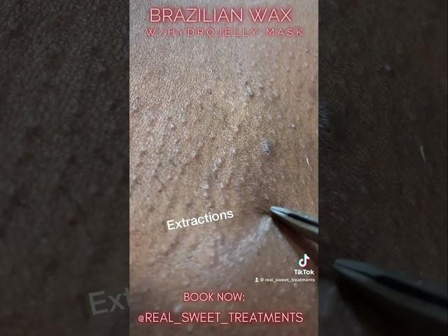 Brazilian Wax with HydroJelly treatment. #brazilianwax #getwaxed #waxing