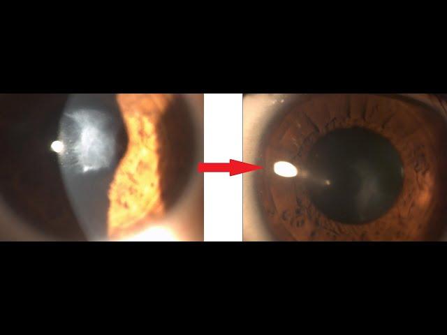 Can Corneal Scars be Treated? Yes LaZrPlastique @GulaniVision