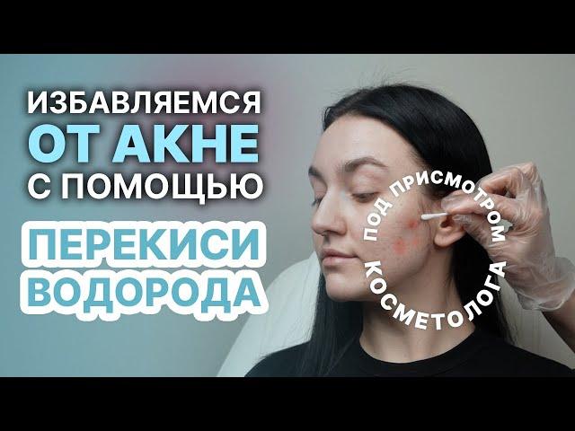 Лечение акне с помощью перекиси - Избавляемся от прыщей!