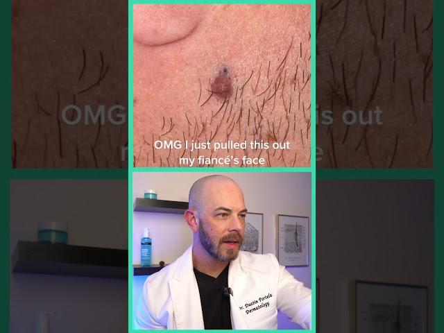 Derm reacts to HUGE ingrown hair! #dermreacts #doctorreacts #ingrownhair