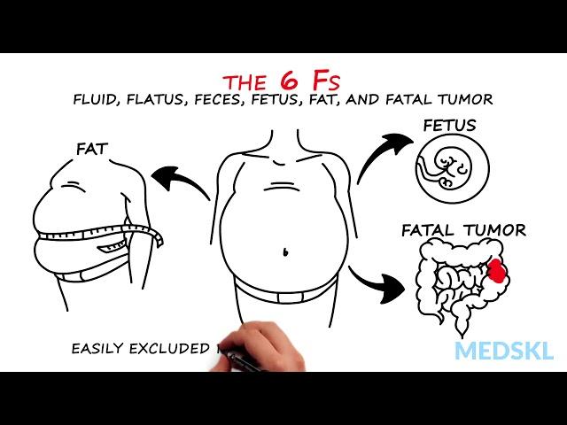 Abdominal Distension: The 6 Fs that can help your diagnosis