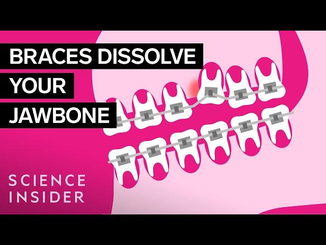 How Do Braces Actually Work?