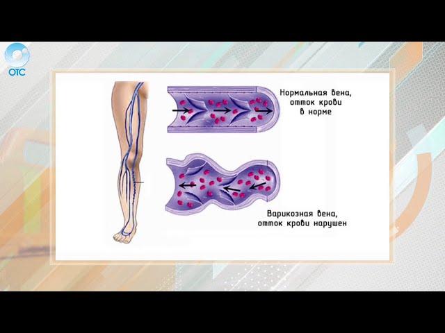 Рубрика "PRO здоровье": варикозное расширение вен