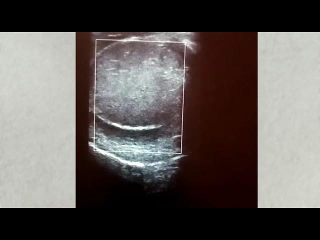 Testicular torsion ultrasound... Dr Albashir Osman Bahar Abakar