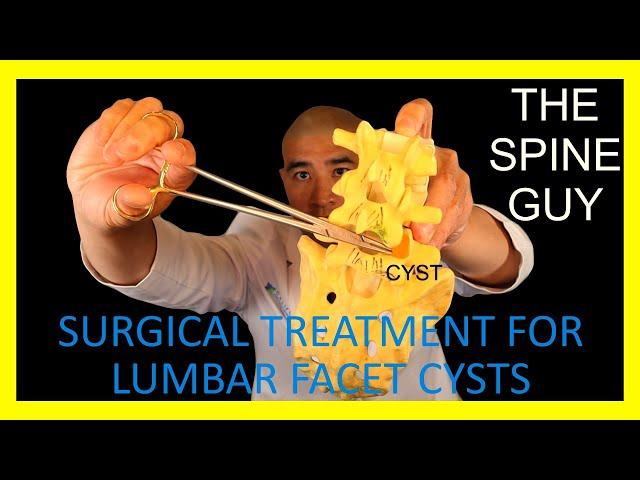 Surgical Treatment for Lumbar Facet Cysts