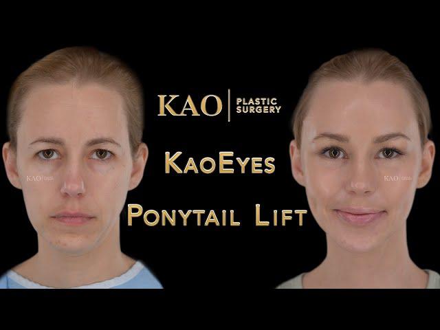 Picture Perfect Plastic Surgery | Scarless Facelift Before & After Video | Ponytail Lift | Dr Kao