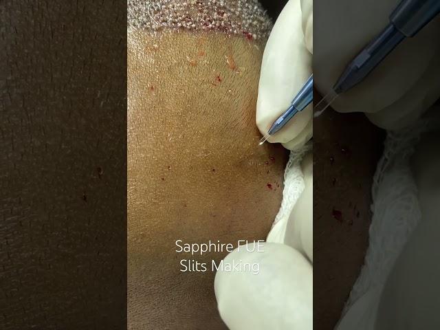 Sapphire FUE Slits Making at Cara Clinic Mumbai | Best Hair Transplant Technique