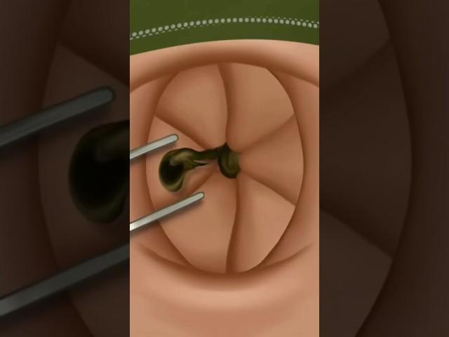 ASMR Satisfying navel stone removal #shorts #ytshorts #youtubeshorts #animation