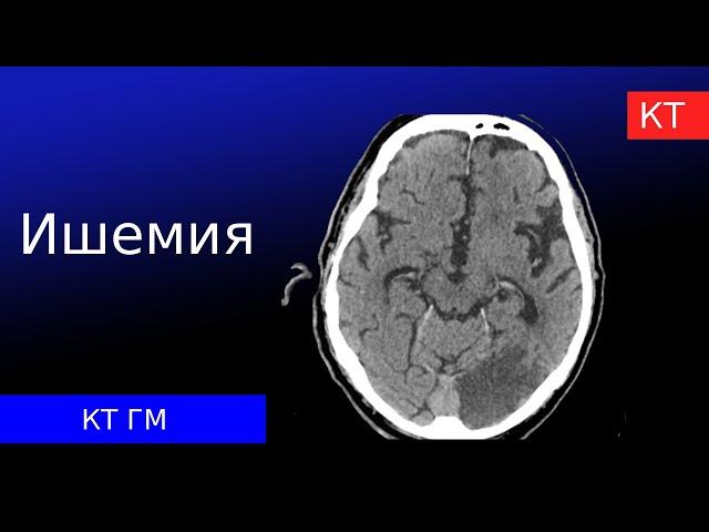 Ишемический инсульт на КТ и гипоксико-ишемическое повреждение головного мозга