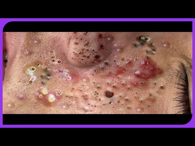 . Satisfying Blackheads Removal: Pimple Popping on Skin 2024