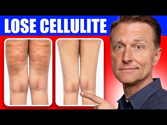 Get Rid of Cellulite for Good: Dr. Berg's Better Way to Lose Flabby Fat