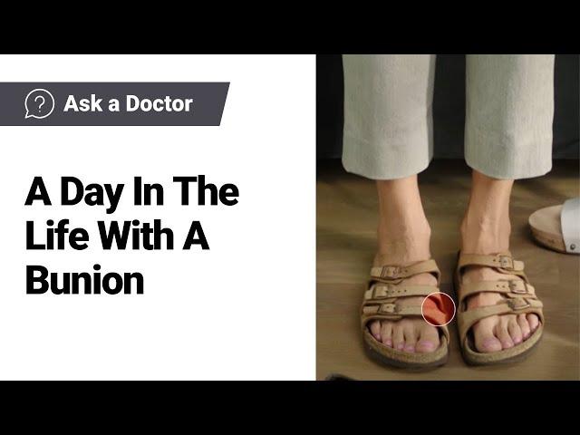 Lapiplasty® 3D Bunion Correction® | A Day In The Life With A Bunion