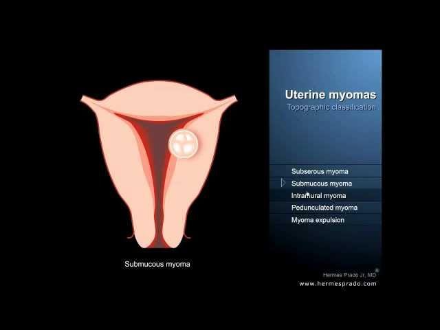 Uterine fibroids or myomas - Definition and symptoms