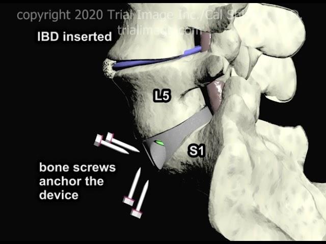 Anterior Lumbar Interbody Fusion (ALIF Part 3) Animation by Cal Shipley, M.D.