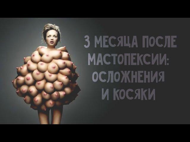 3 МЕСЯЦА ПОСЛЕ МАММОПЛАСТИКИ И МАСТОПЕКСИИ: осложнения и косяки