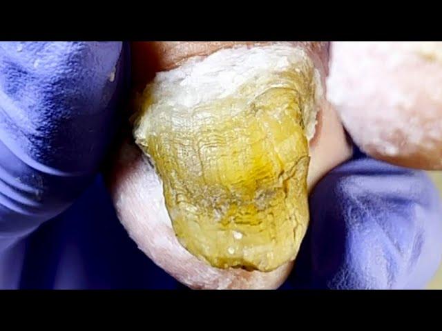 Jade Like Onychomycosis, Hollowed Out Step By Step【Xue Yidao Pedicure】