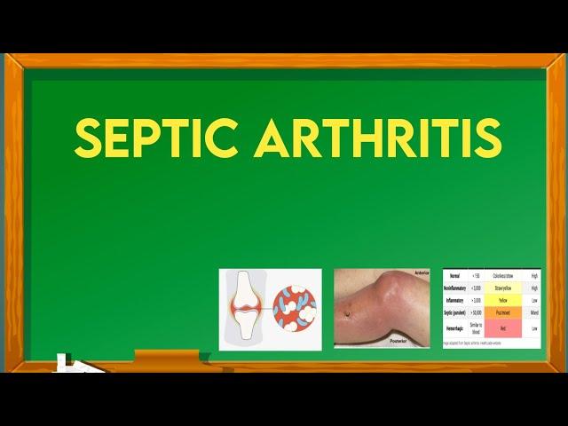 septic arthritis  risk factors, causes , sign and symptoms, diagnosis and treatment  @ImMEDICAL.