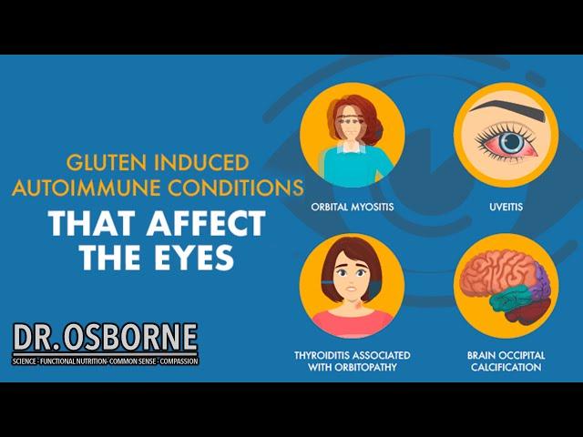 Gluten induced autoimmune diseases that affect the eyes