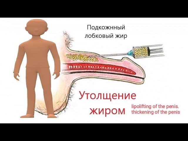 Липофилинг полового члена. lipolifting of the penis. thickening of the penis.