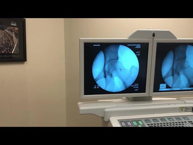 Intra-Articular Injection of the Hip Under Fluoroscopic Guidance