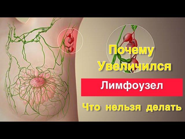 Почему увеличился лимфоузел. Что делать нельзя 