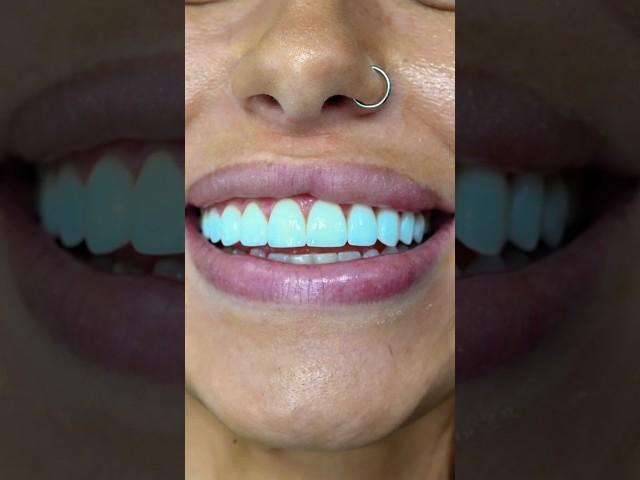 No Drilling Veneers Procedure Before and After 2023 #shorts #patienteducation #cincinnati #veneers