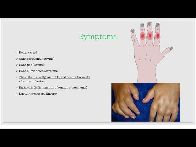 Reactive arthritis / Post-infectious arthritis [Essential medicine]