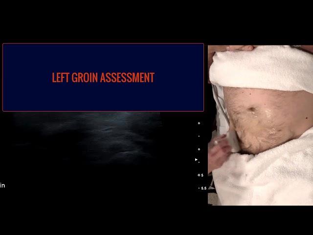 Groin Hernia Ultrasound Part 2