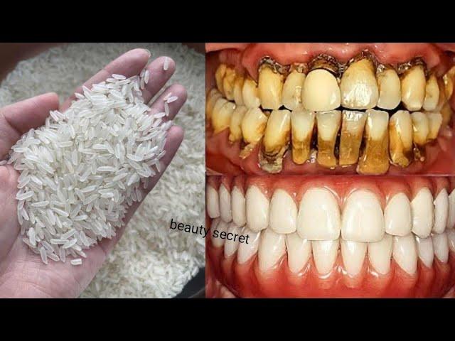 The recipe that dentists are hiding from us!It whitens teeth and eliminates tartar in 1 minutes