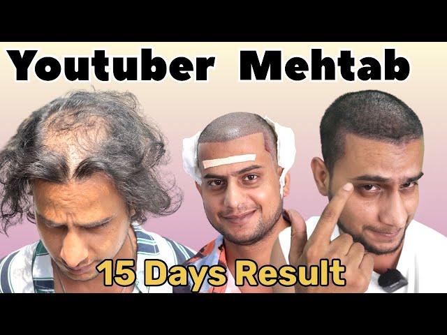 Round 2 Hell fame Mehtab’s 15 days Hair transplant Result | Best Hair transplant Result in india