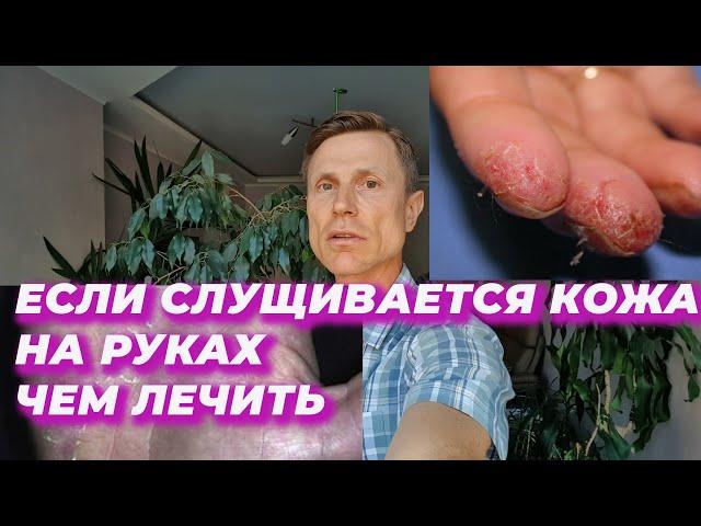 Если слущивается кожа на руках. Чем лечить.