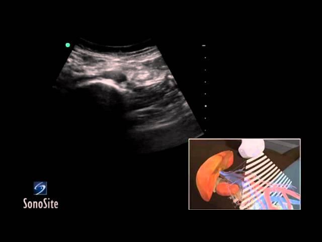 How To: Abdominal Aorta Ultrasound 3D Video