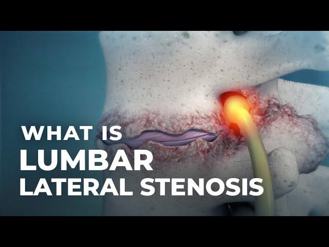 Lumbar Lateral Stenosis | @Atlantic Spine Center