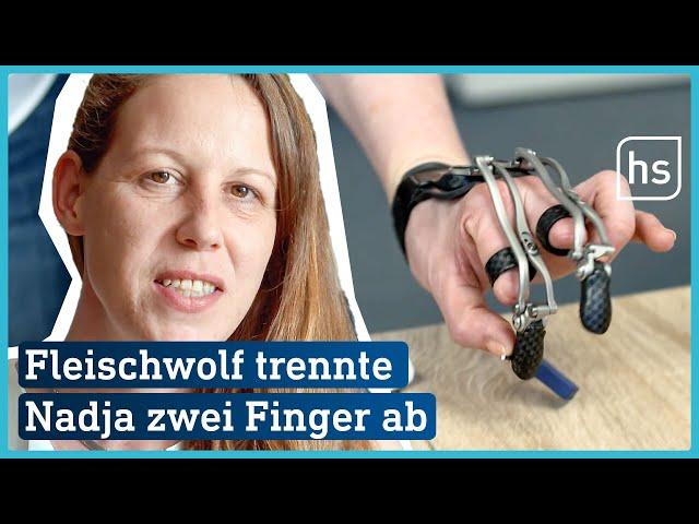 Köchin arbeitet nach Arbeitsunfall mit Fingerprothese | hessenschau