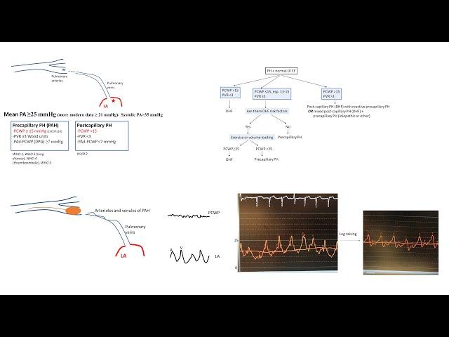 Pulmonary hypertension hemodynamics: misunderstood concepts, tips and tricks- Elias Hanna, Univ Iowa