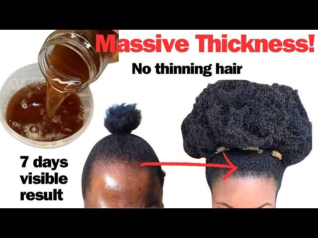 THE MOST EFFECTIVE HAIRLOSS REMEDY Stops Hair Thinning and Thickens Hair. How to Stop Hairloss