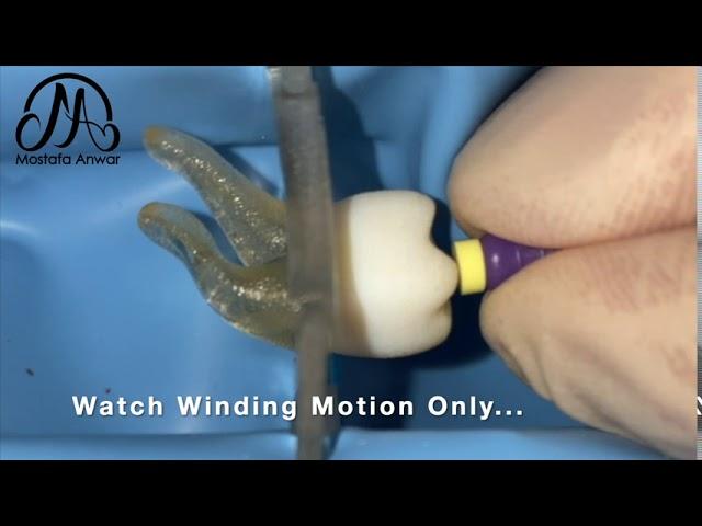 How to Achieve Patency during Root Canal Treatment using One Manual File? | Double Curvature Canal..