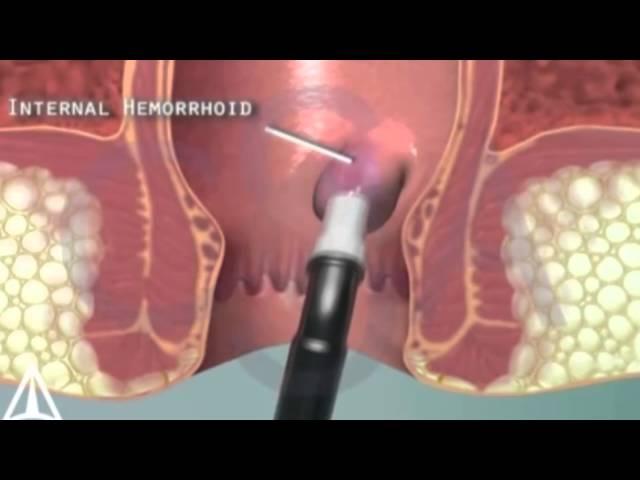 Геморрой - бесшовный способ лечения
