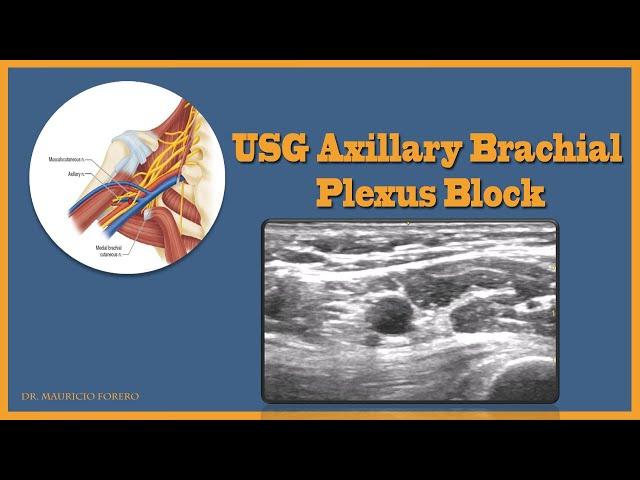 USG Axillary Brachial Plexus Block