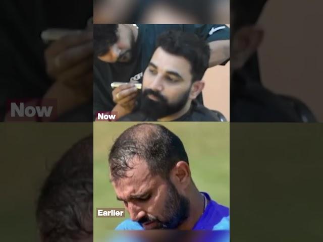 Mohd Shami's Hair Transplant Results at Eugenix: Before & After 10 Months Results