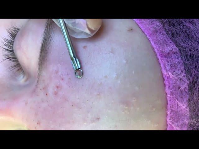 Satifying videos blackhead extraction  | removing cystic acne  |  черные  точки | акне