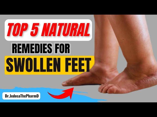 5 Natural Remedies to Reduce Swollen Feet and Ankles Fast