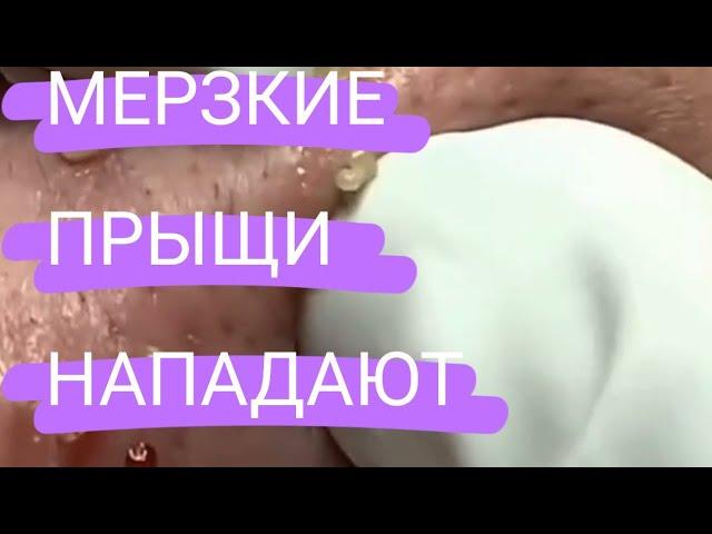 see acne removal!№24 ВЫДАВЛИВАНИЕ ПРЫЩЕЙ!