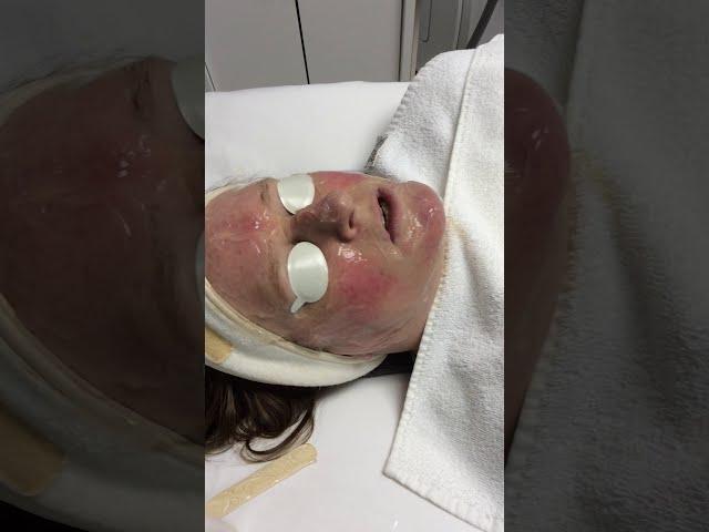 Urban Body Laser Skin Rejuvenation And Laser Hair Removal Call 604-696-5506