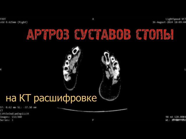 АРТРОЗ МЕЛКИХ СУСТАВОВ стопы и ОСТЕОПОРОЗ 3 степени на расшифровке КТ стопы (второе мнение)