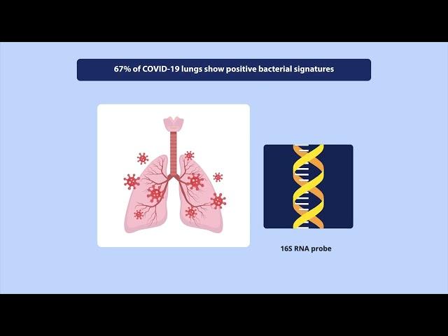 COVID-19 Lung Disease Leads to Blockage of Bronchi from Excess Mucus Build-up