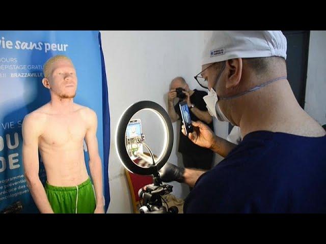 Congo: Brazzaville clinic helps embattled albino minority