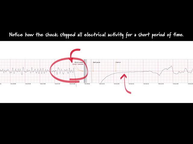 ECG Steve Save | SaveStation